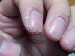 指先の湿疹(進行性指掌角皮症)