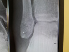 右足腓骨(ひこつ)亀裂骨折治療記