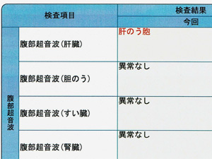 2024年人間ドックの結果(肝のう胞とALT基準値超え)